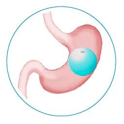 A gastric balloon after being inflated in the stomach.
