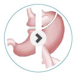 A stomach undergoing bariatric revision surgery.